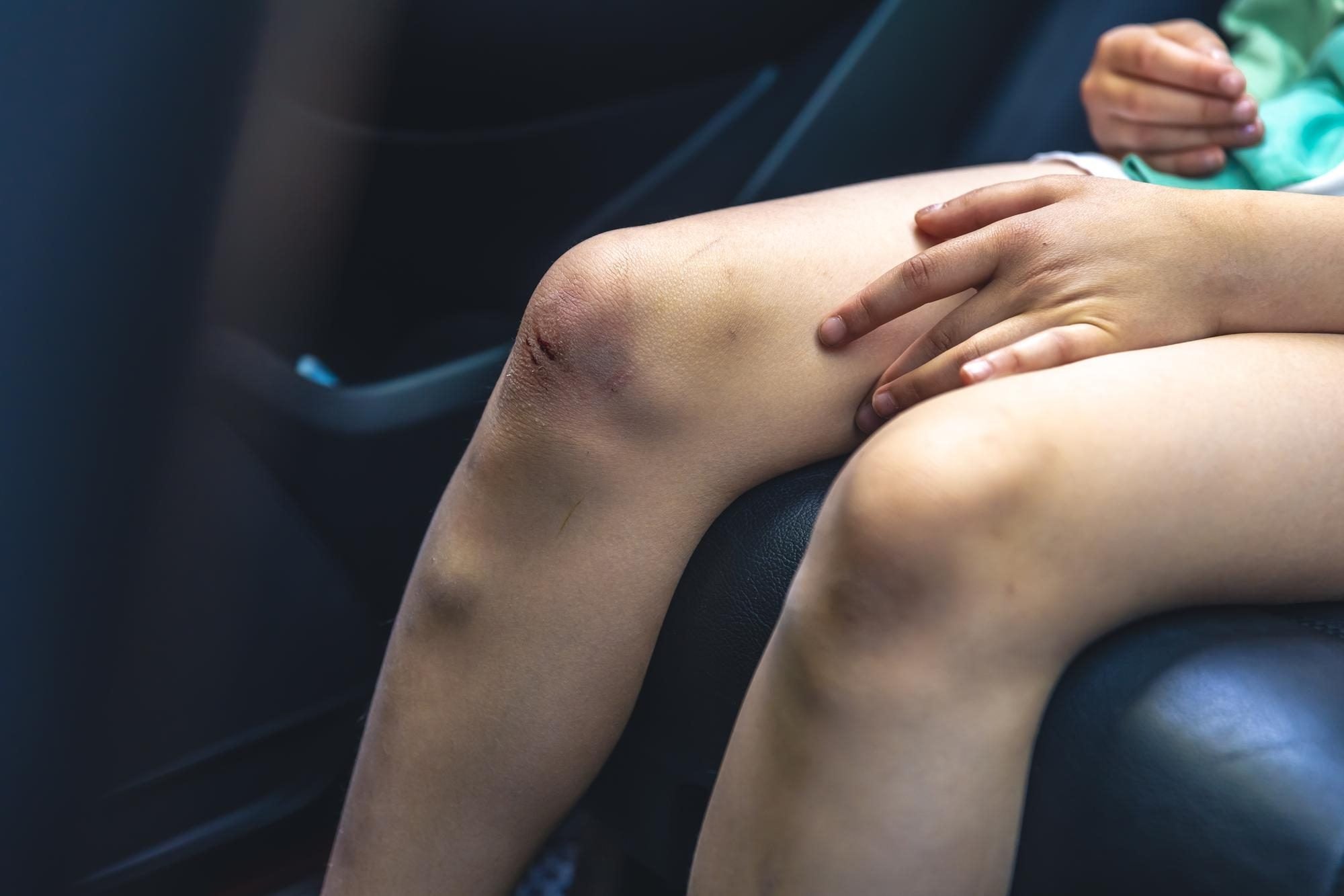 What Is Leg Edema and When Should You Worry About It?