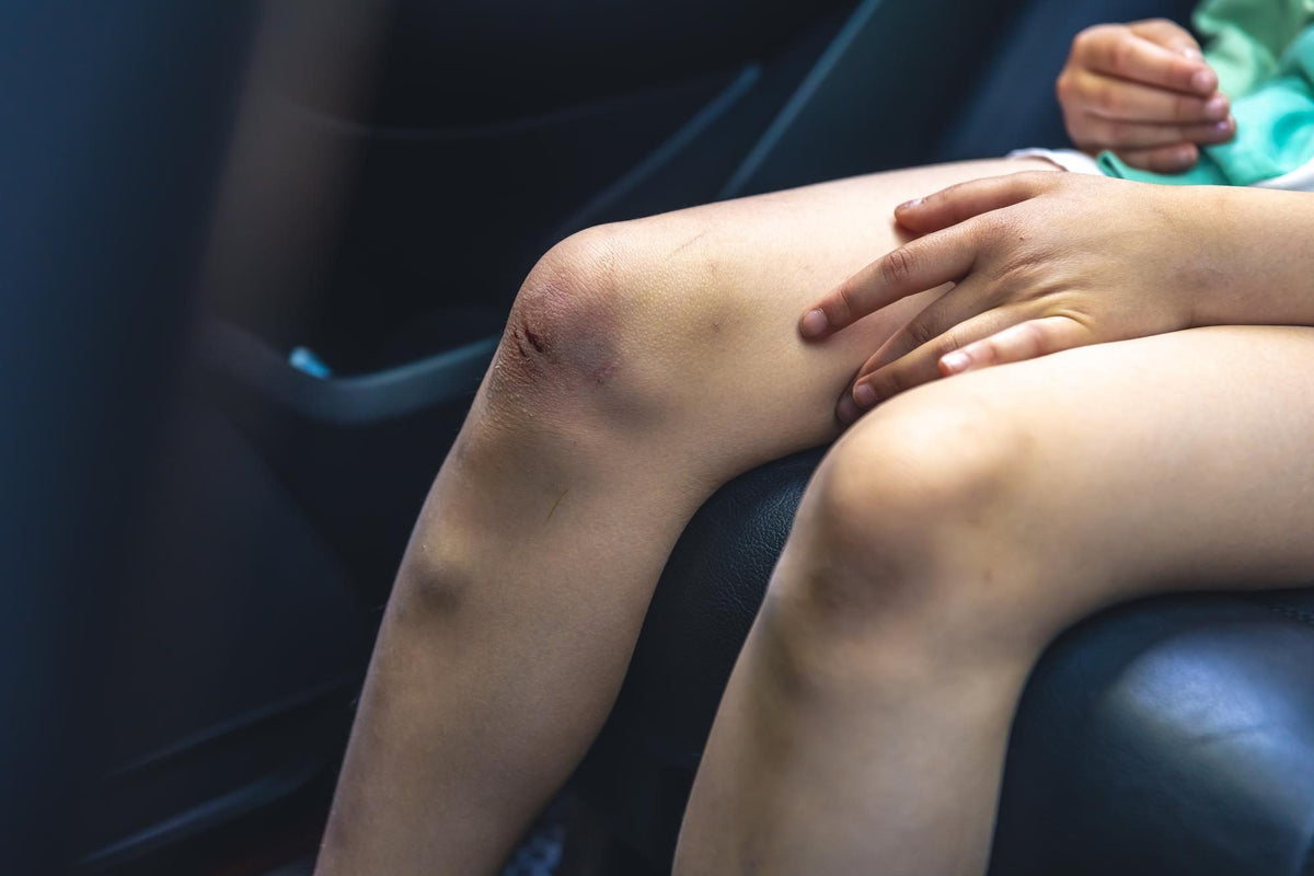 What Is Leg Edema and When Should You Worry About It?