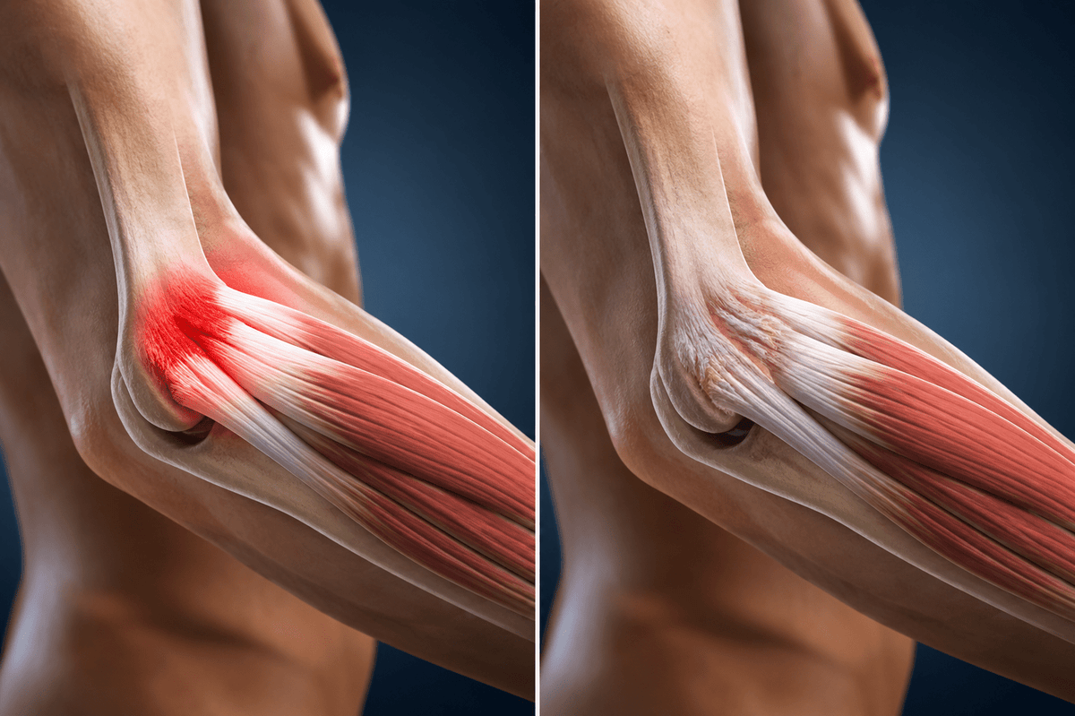 What’s the Difference Between Tendonitis and Tendinosis?