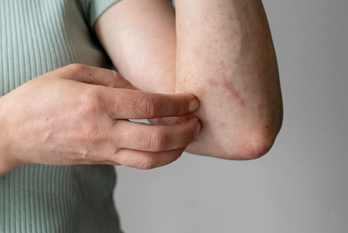 Reasons and Treatment of Compression Sleeve Rash